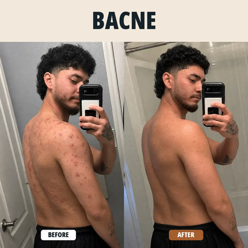 BODY ACNE WASH
