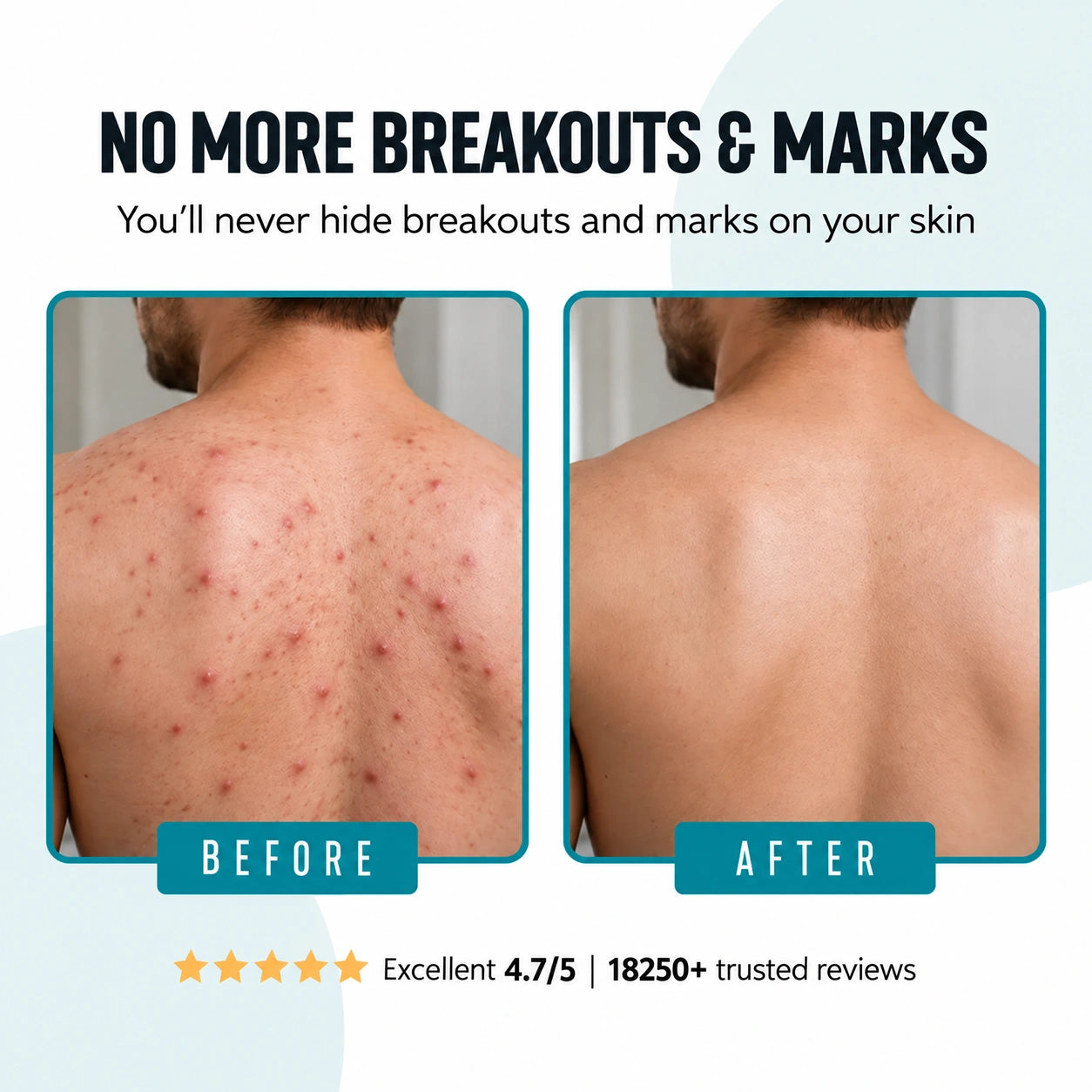 ODYSSEUS BODY ACNE WASH