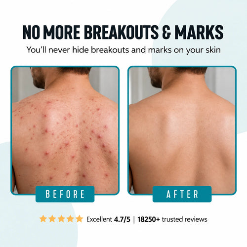 ODYSSEUS BODY ACNE WASH
